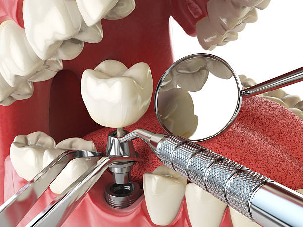 Best Emergency Tooth Extraction in Crompond, NY